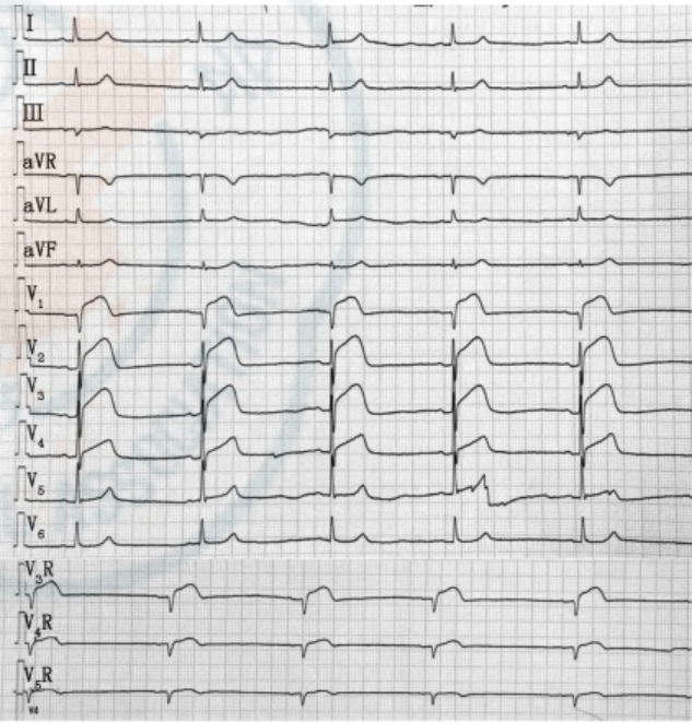 图6 患者行pci术后(胸背痛20 min)12导联及右胸导联心电图:v1~v4导联