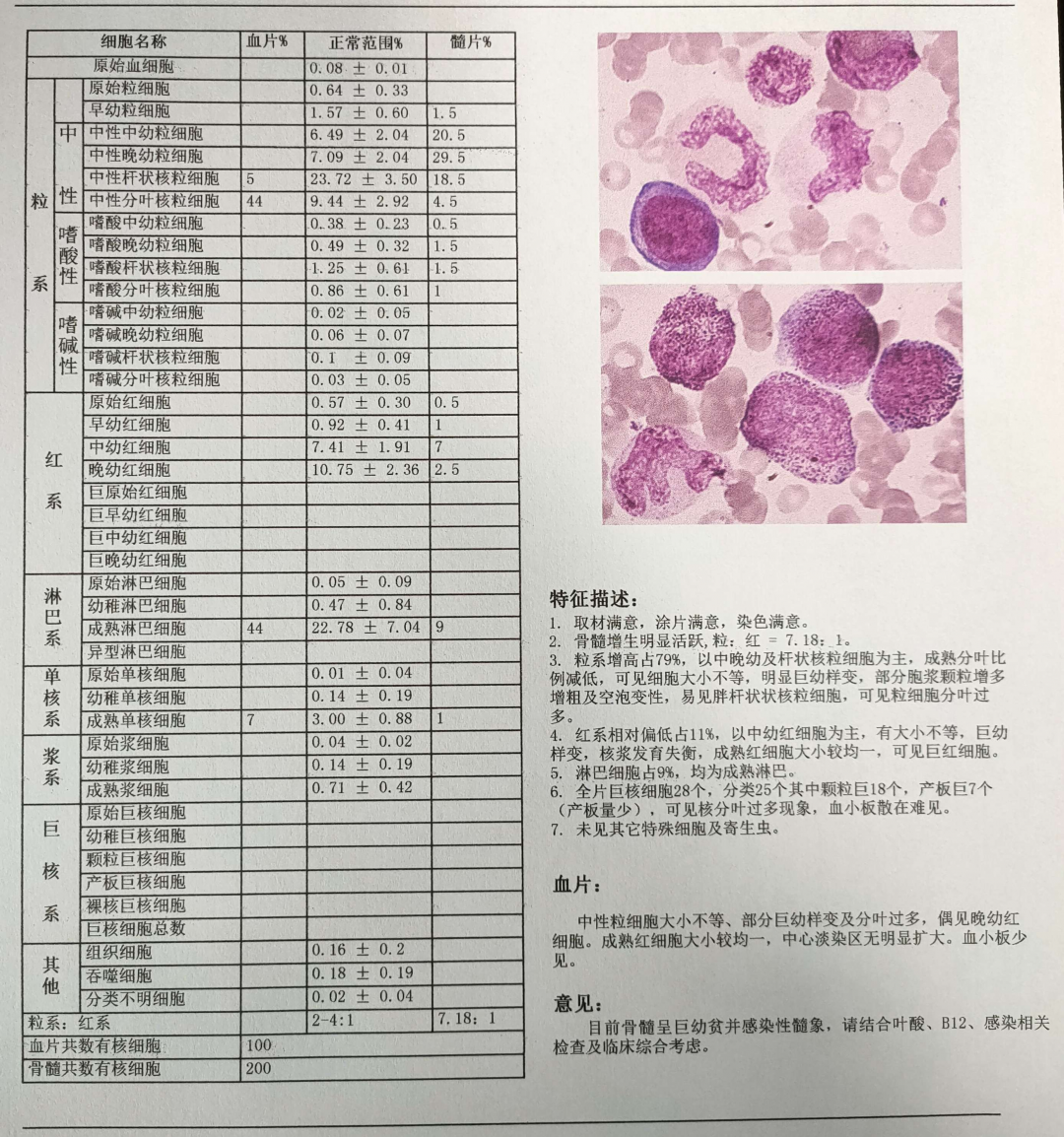 图56 缺铁性贫血骨髓象-血液学细胞学-医学