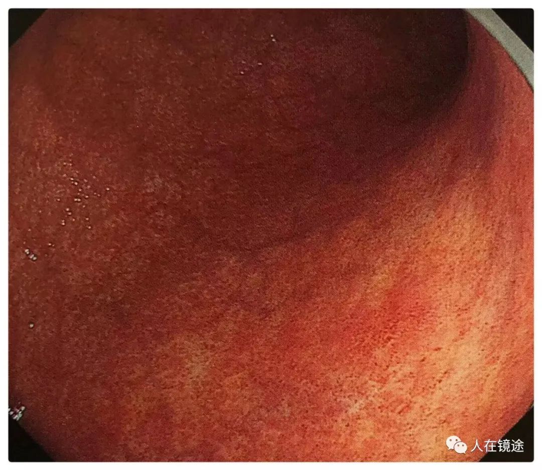 早期胃癌筛查再认识:「胃癌四角」详解及临床意义_医学界-助力医生