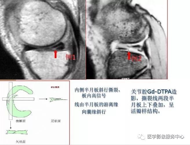 膝关节各种损伤的mri表现大集合 医学界 助力医生临床决策和职业成长