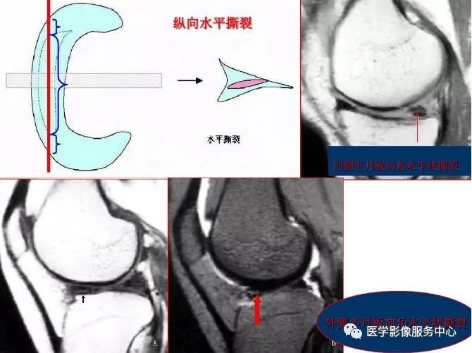 膝关节各种损伤的mri表现大集合 医学界 助力医生临床决策和职业成长