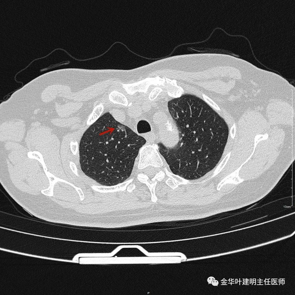 兩肺多發磨玻璃結節持續存在會是肺癌嗎