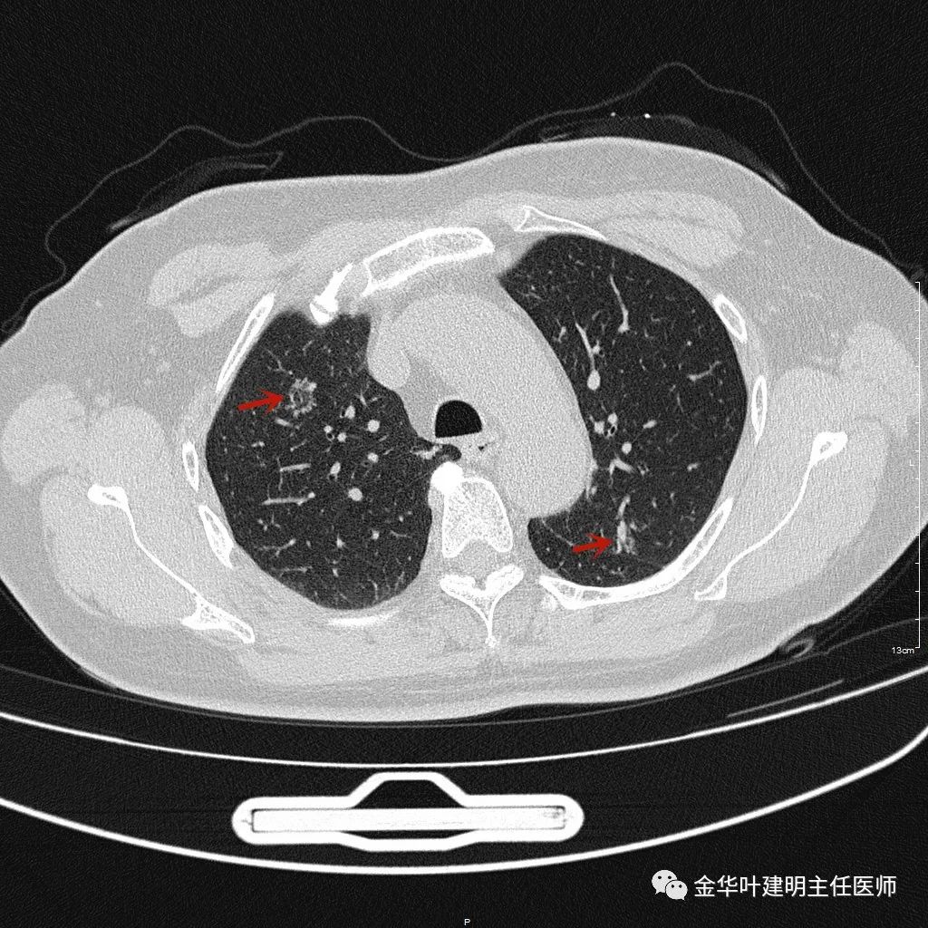 兩肺多發磨玻璃結節持續存在會是肺癌嗎