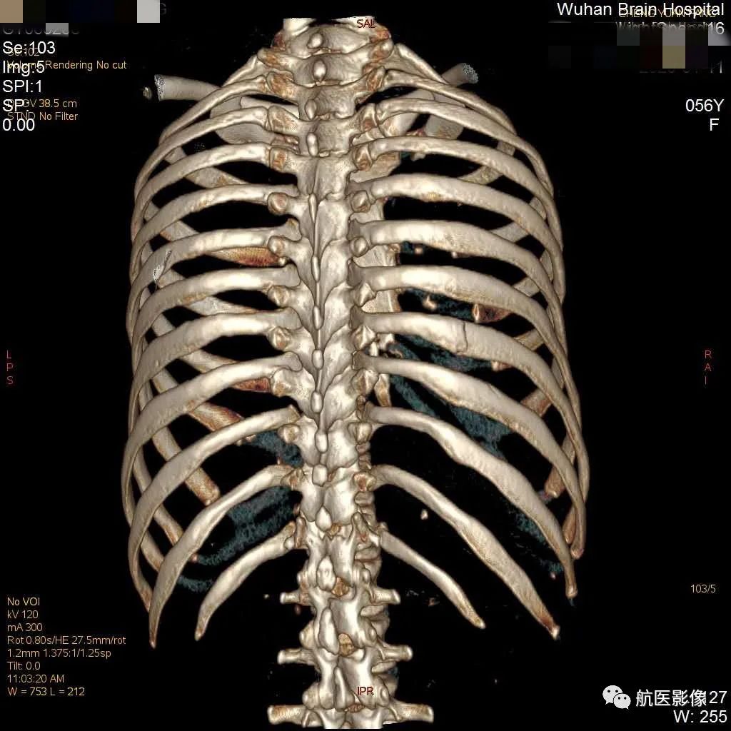 为什么肋骨骨折 Ct扫描一定要做三维成像 医学界 助力医生临床决策和职业成长