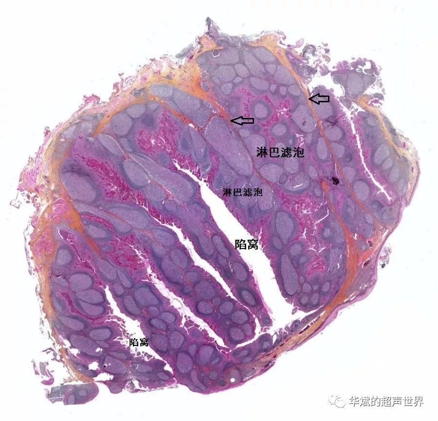 慢性扁桃体炎切片图片图片