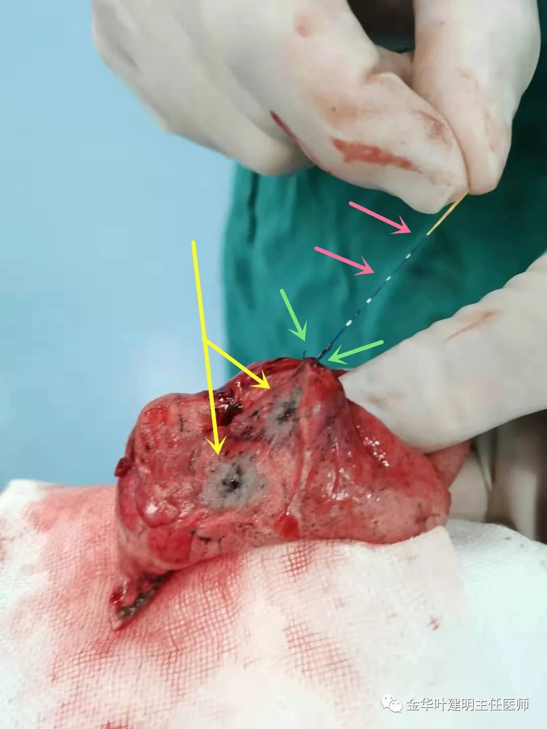 肺小结节该怎么定位除了有创还有这种方法