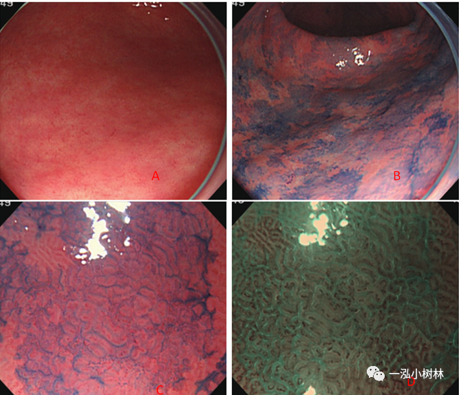 内镜锦囊肠上皮化生的内镜诊断