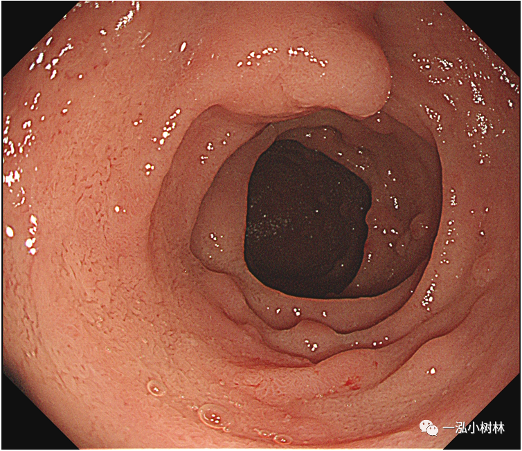 内镜锦囊肠上皮化生的内镜诊断