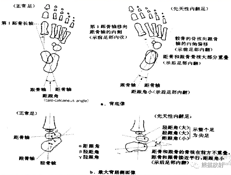 x线诊断要点丨骨与关节发育畸形(下肢)_医学界-助力医生临床决策和