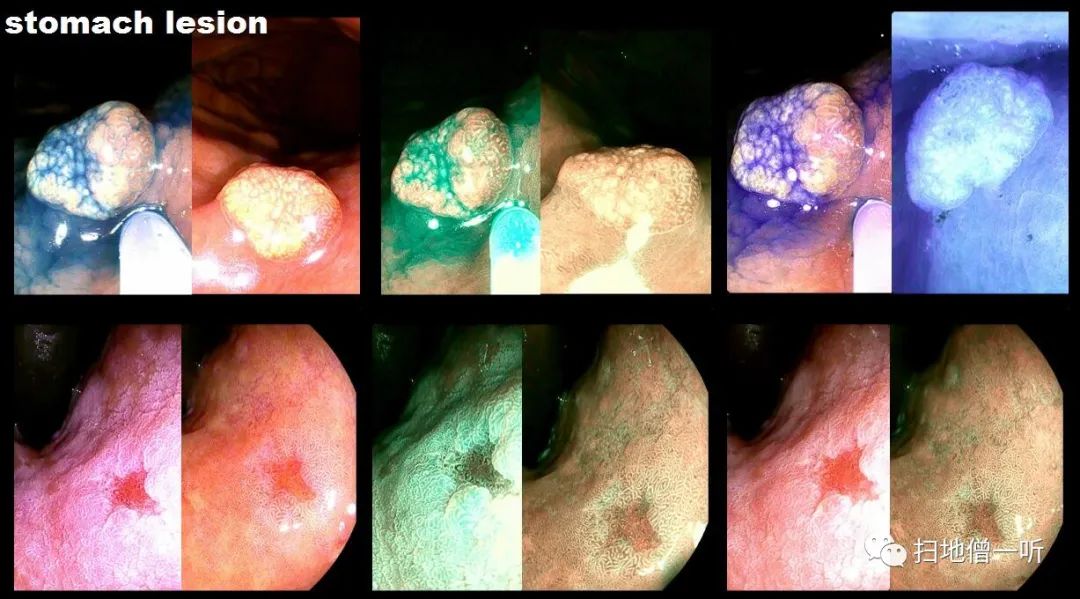 时候,倒镜状态下对小弯,贲门,胃底进行了观察,正镜状态下对胃窦,大弯