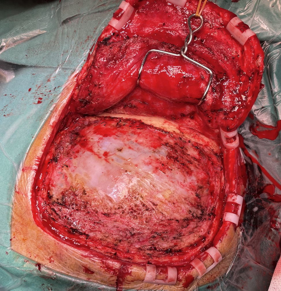 李克勤 教授:长期服用阿司匹林自发性脑出血一例手术汇报