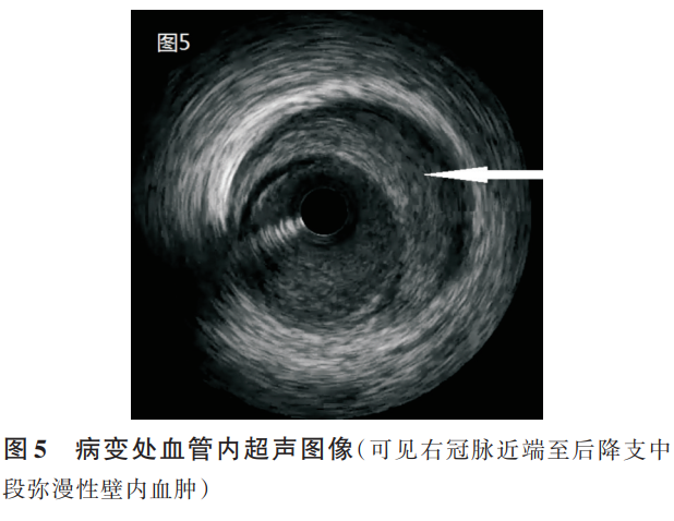【病例报告】药物保守治愈右冠状动脉自发壁间血肿1例_医学界-助力医生临床决策和职业成长