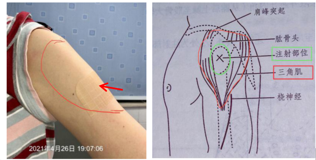 肩周炎的三点注射图片