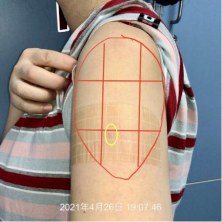 接种疫苗三角肌位置图图片