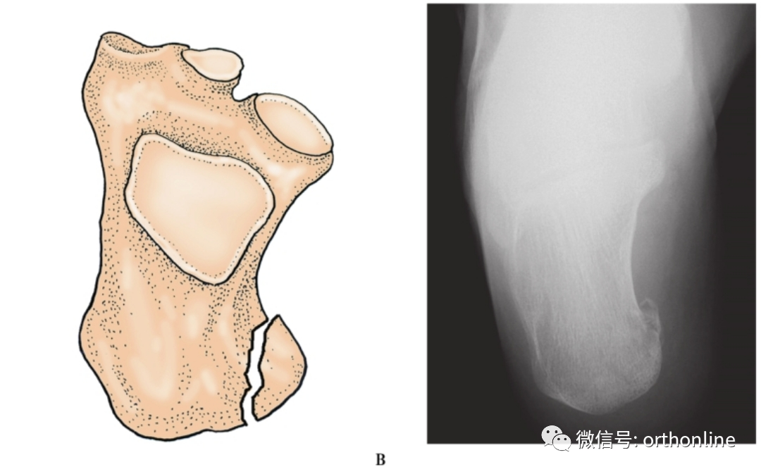 a.Ⅰ型:骨折未累及距下關節a跟骨結節骨折:a1鳥嘴樣骨折.