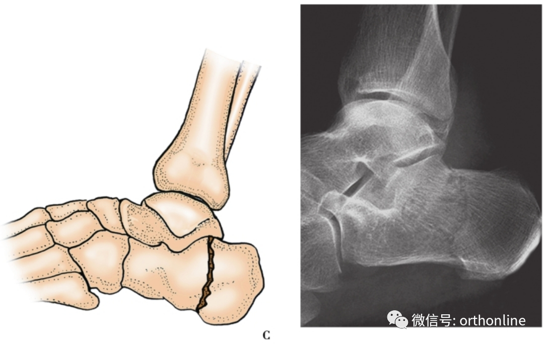 收藏|多圖詳解5種常見跟骨骨折分型_醫學界-助力醫