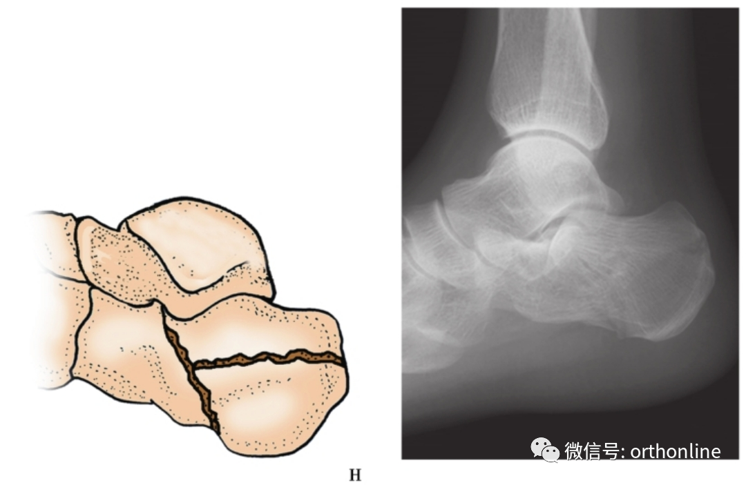 收藏|多图详解5种常见跟骨骨折分型