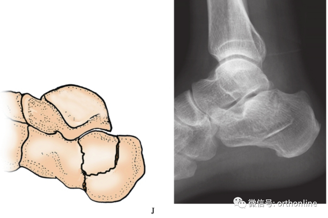 收藏|多图详解5种常见跟骨骨折分型_医学界-助力医生临床决策和职业