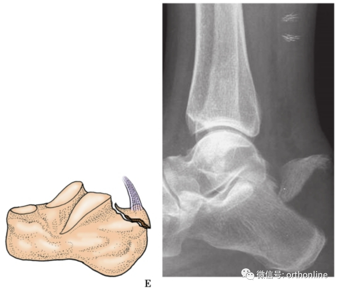 微创精准理念下的距骨骨折的手术治疗 ——踝关节镜下见真章 - 徐州市中心医院