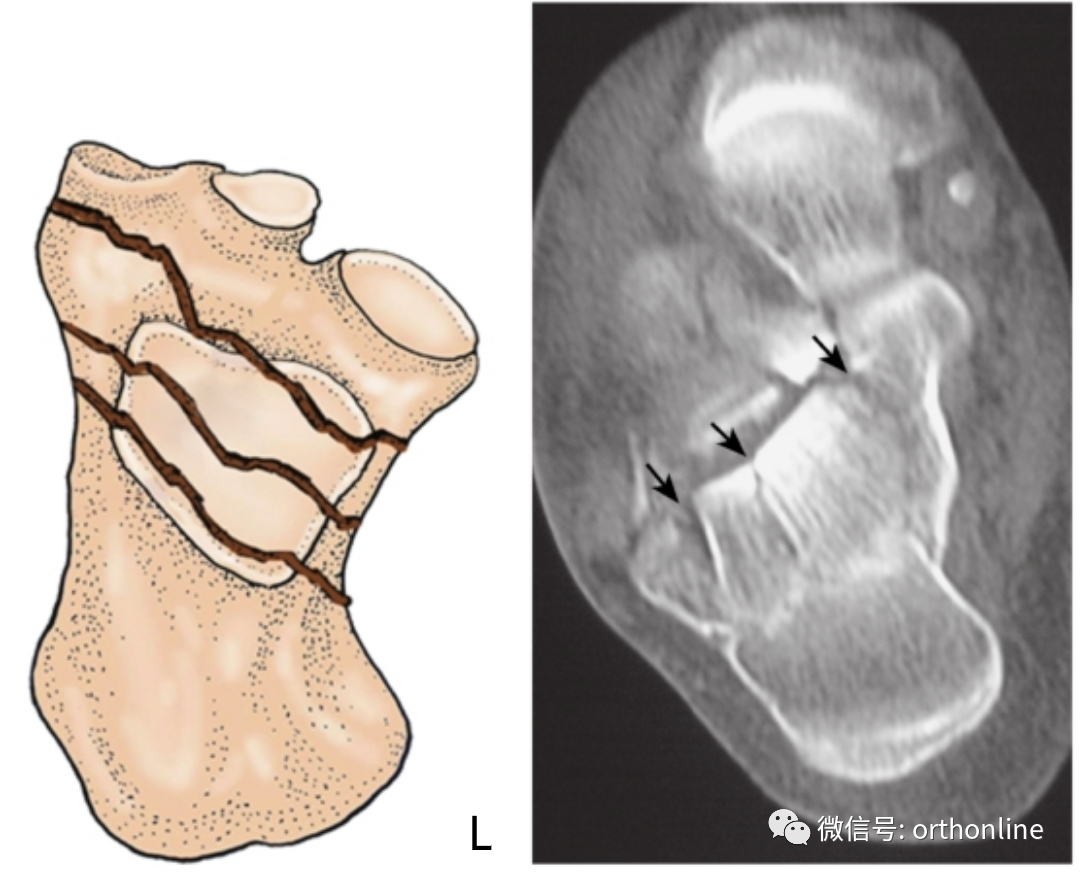 l.c4≥四部分骨折四,按解剖部位分型a.跟骨前突骨折b.跟骨結節骨折c.