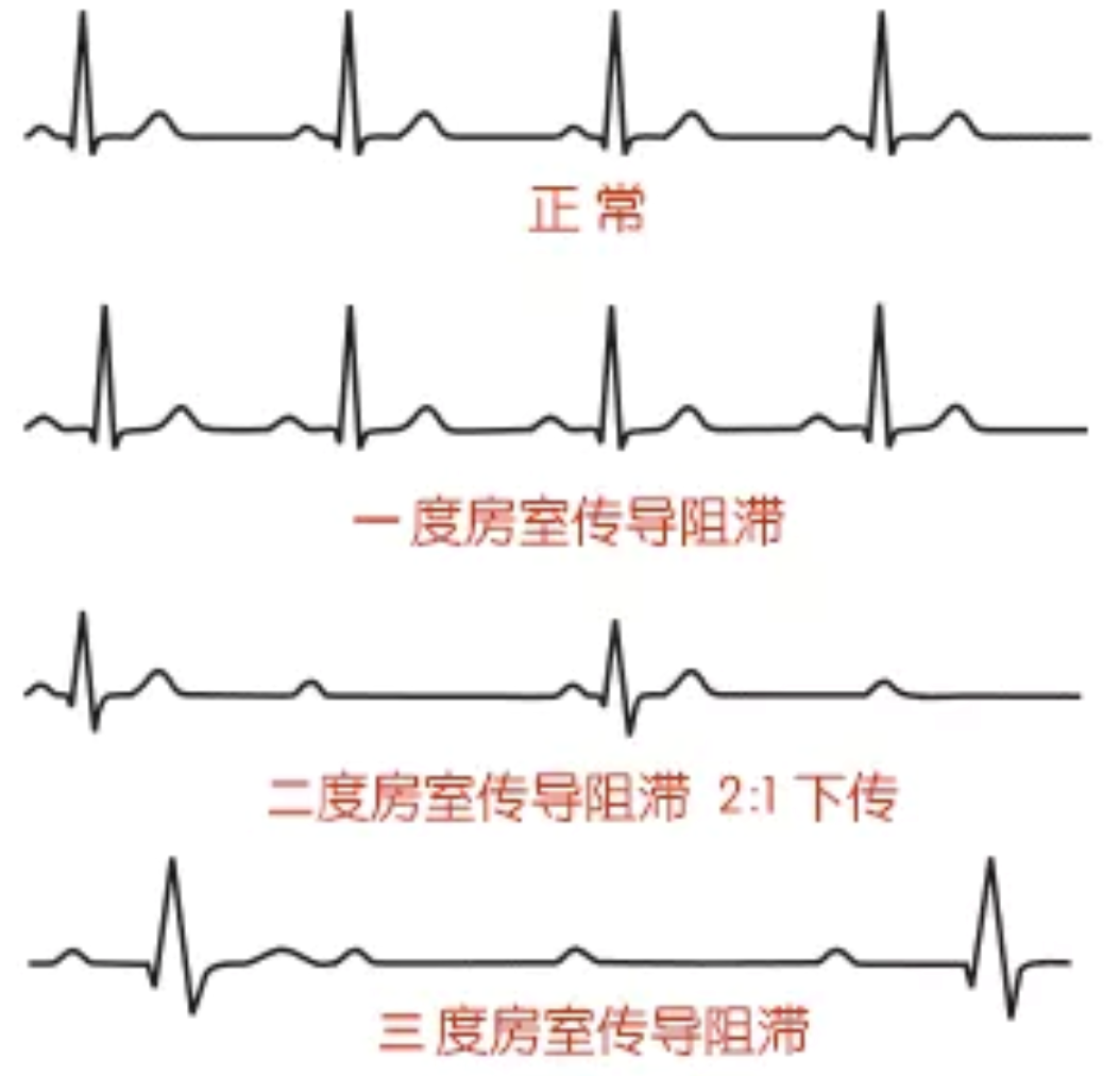 五、心电图各波段的命名及测量-临床心电图教学-医学
