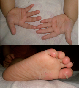 这些水泡在1周内开始消退,跖部脱皮(手足口病的不典型表现),1个月内