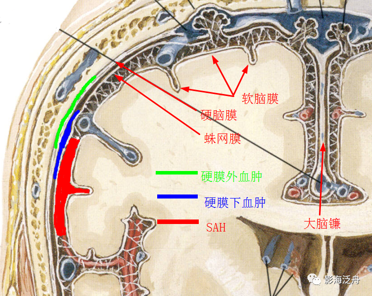 大腦鐮旁急性硬膜下血腫與蛛網膜下腔出血的鑑別_醫學界-助力醫生臨床