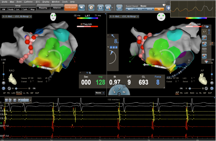 精彩病例:房颤射频消融术中窦房结动脉损伤一例