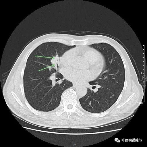 实性结节若有典型恶性影像,不建议穿刺_医学界-助力医生临床决策和