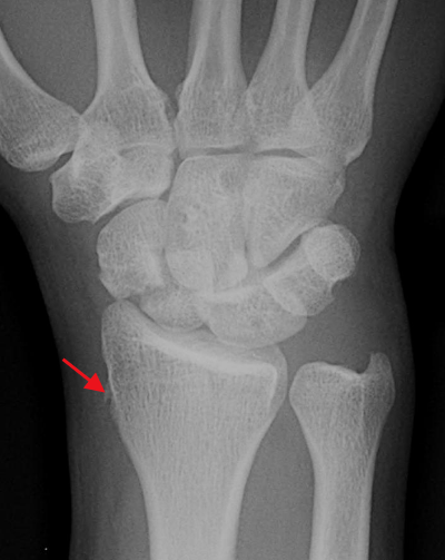 经舟骨月骨周围骨折脱位 医学界 助力医生临床决策和职业成长