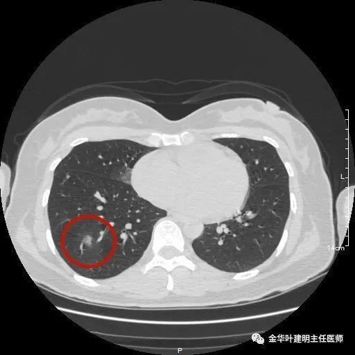 这种肺结节,让人惊掉下巴_医学界-助力医生临床决策和职业成长
