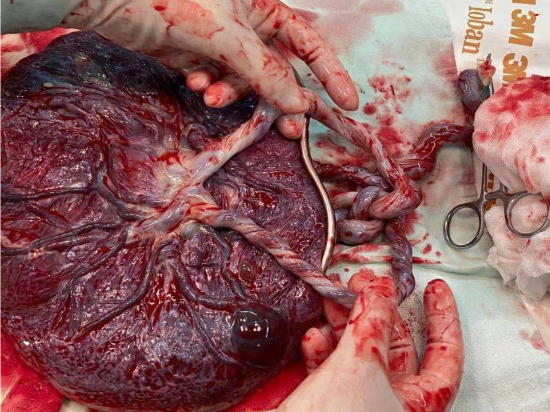 孕中期产前超声诊断单绒单羊双胎合并脐带缠绕一例