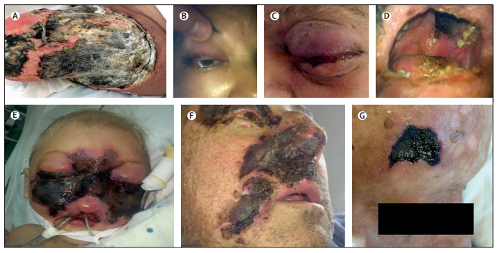 印度新冠患者病情雪上加霜,毛霉菌病已致死200多人_医学界-助力医生