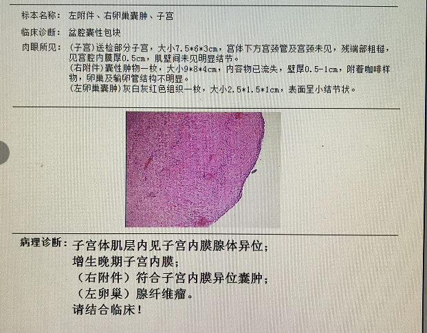 术后病理:子宫体肌层内见子宫内膜腺体异位,左右卵巢子宫内膜异位囊肿