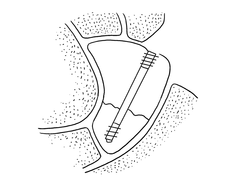 舟骨骨折;b.复位后舟骨herbert钉内固定;c.