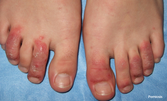 气候变化竟与皮肤病息息相关,这些有趣病例你见过吗?