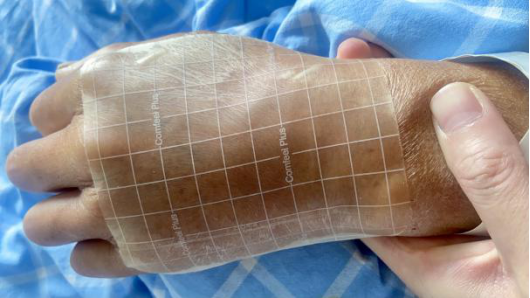 药物外渗,用土豆皮还是硫酸镁?答案是.