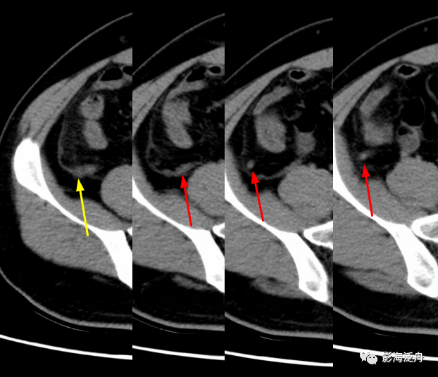 小心误诊,这可不是急性阑尾炎_医学界-助力医生临床决策和职业成长