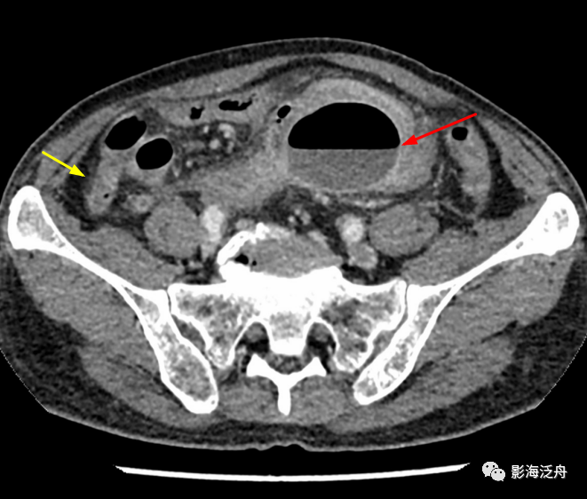 小心误诊,这可不是急性阑尾炎_医学界-助力医生临床决策和职业成长