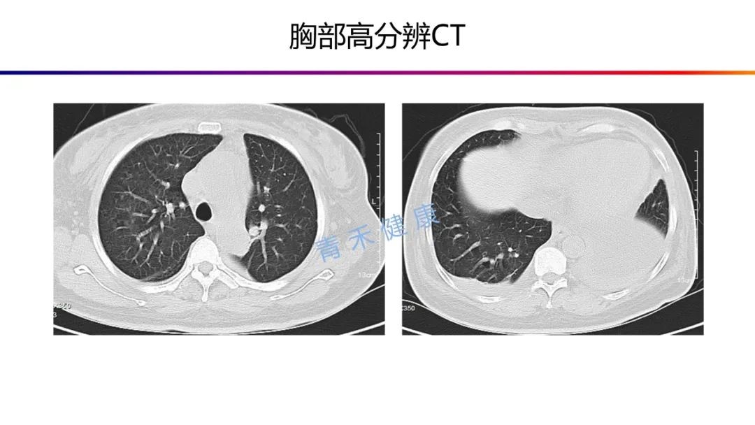 sle伴多系统损害-肺萎缩综合征_医学界-助力医生临床决策和职业成长