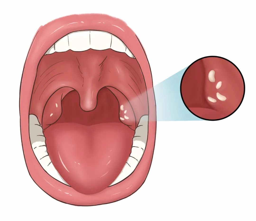 臭味酸爽的扁桃体结石 该如何治疗 医学界 助力医生临床决策和职业成长