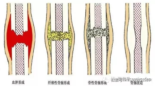 骨头愈合过程示意图图片