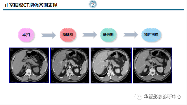 胰腺炎ct图片图解图片