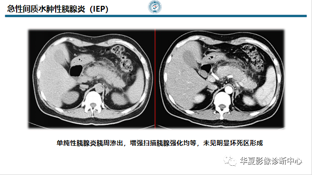 急性胰腺炎ct診斷與嚴重度分級