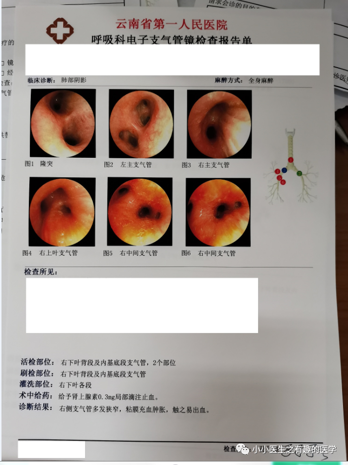 有趣病例这种ct一看就是肺炎型肺癌