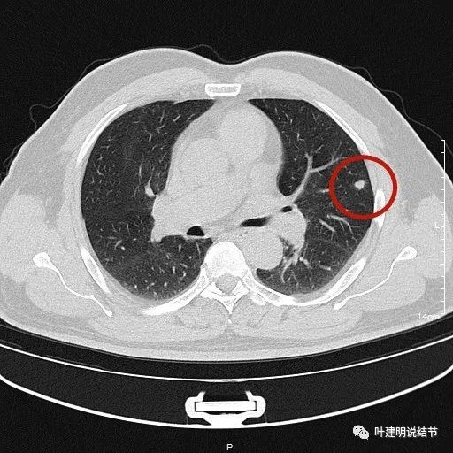 隨訪進展的肺多發實性結節,會是啥?_醫學界-助力醫生臨床決策和職業成