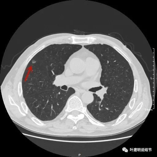 右肺中叶图片图片