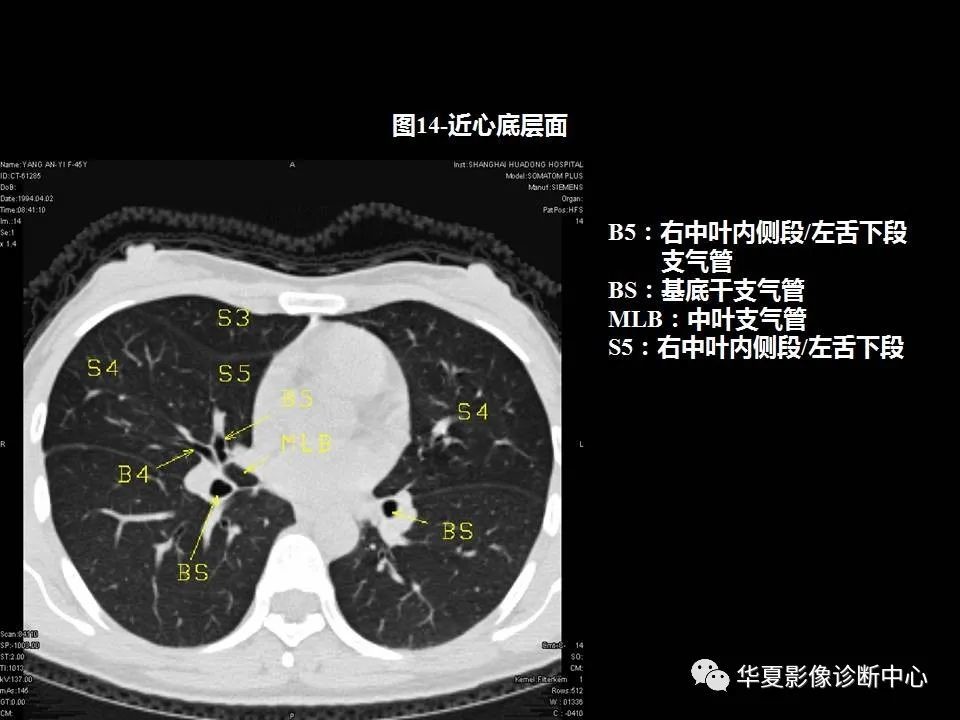 肺段ct解剖與肺部常見病變解析