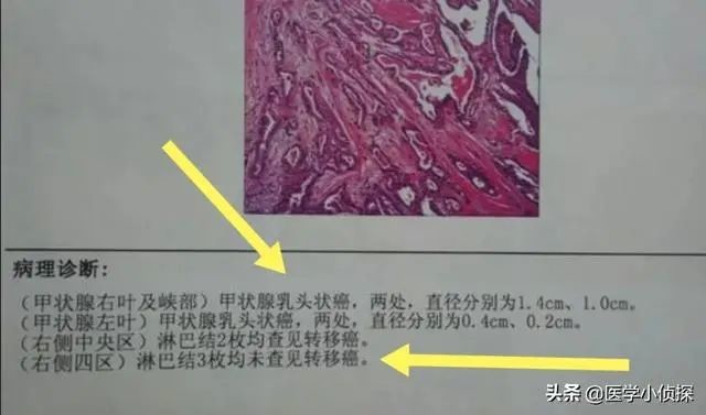甲状腺癌真正能活几年 这是见过最科学 合理的解释 医学界 助力医生临床决策和职业成长
