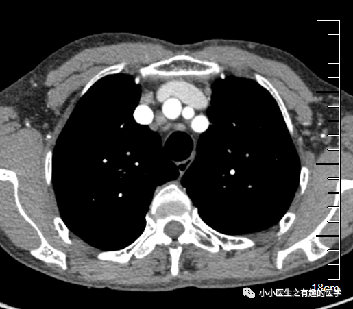 有趣病例肺癌患者縱隔淋巴結腫大不一定是轉移